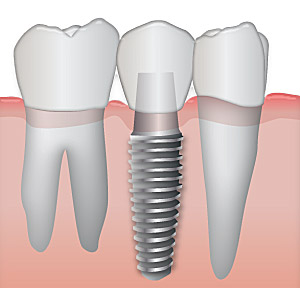 dental implants