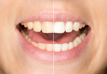 A whiter smile is a brighter smile with teeth whitening in Rocky Hill, CT