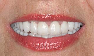 a restored smile with dental implants