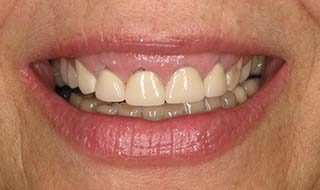 Dr. Michalski's patient before restoration with dental implants