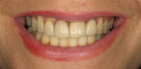 a smile before porcelain veneers