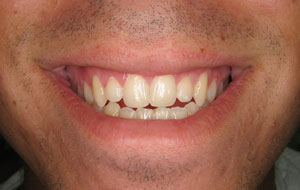 a patient after gum recontouring