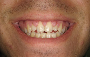 a patient before gum recontouring