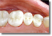 teeth with composite fillings from a mercury-free dentist