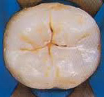 a tooth before dental sealant