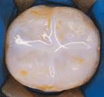 a tooth after dental sealant