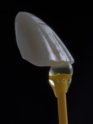 Porcelain veneer
