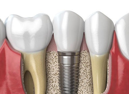 Model of a tooth implant in the gums and bone with natural teeth on either side.