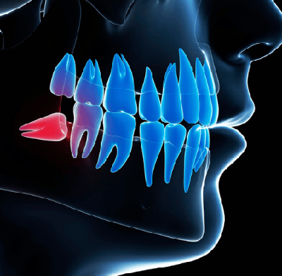 Impacted third molar for which a patient wants to see an emergency dentist near me