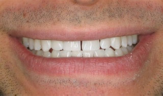 a patient before teeth whitening