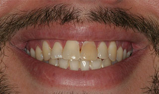 a patient before teeth whitening