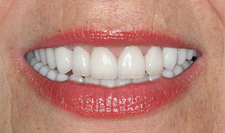 full mouth reconstruction after
