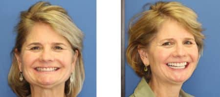 Before-and-after photos showing the smile transformation of a patient who received cosmetic dentistry treatment with Dr. Michalski.