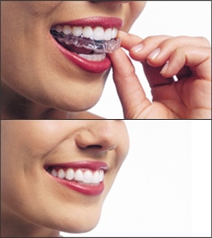 Top photo shows a woman's smile as she places an Invisalign aligner over her teeth. Bottom photo shows her smile with the aligner in place.