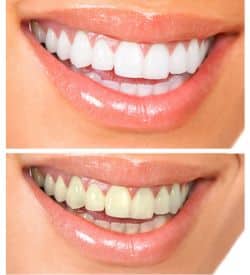 Two photos showing a woman's smile before and after teeth whitening treatment. 