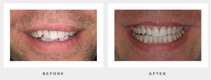 Before and after dental bonding pictures from Dr. Michalski